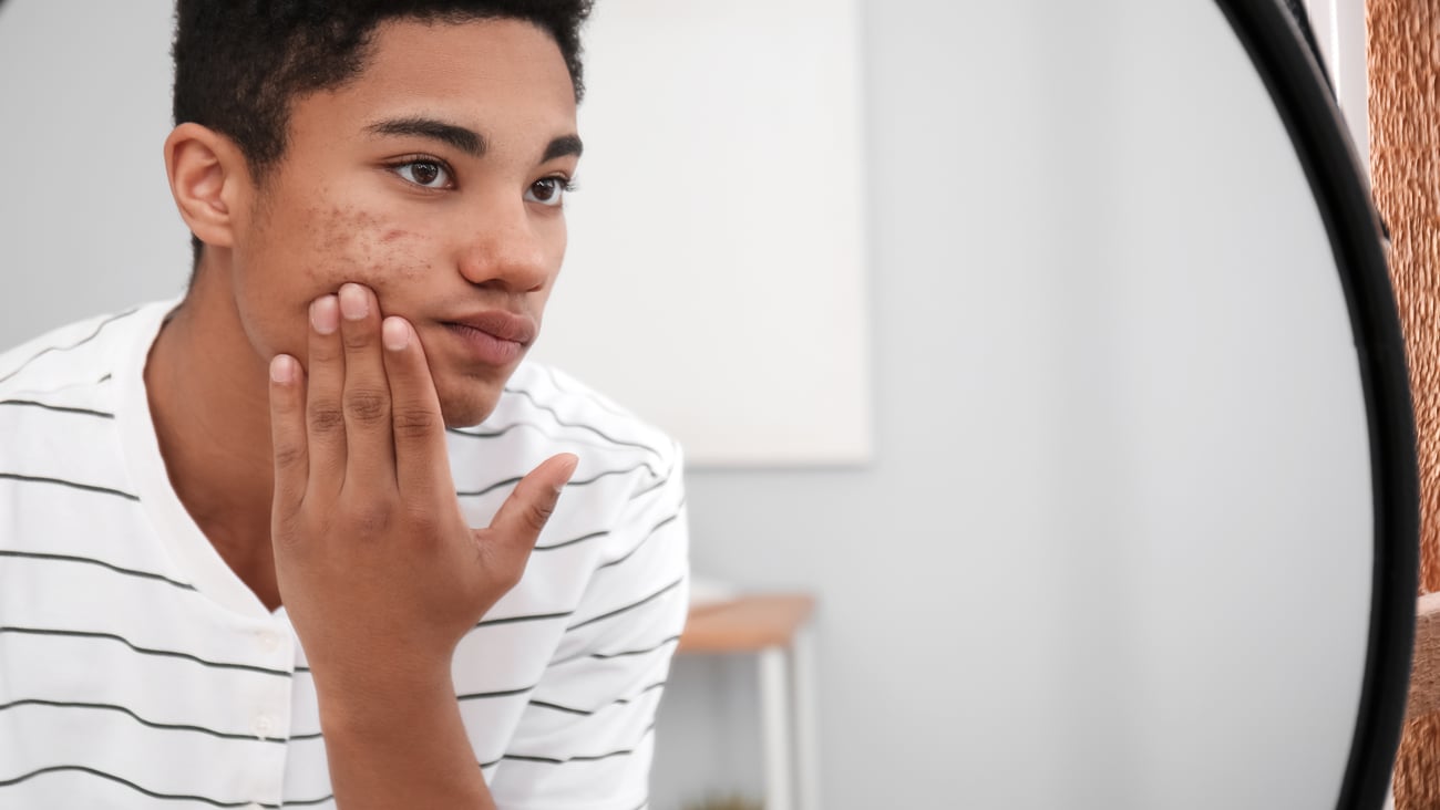 Young man looking at his acne in the mirror