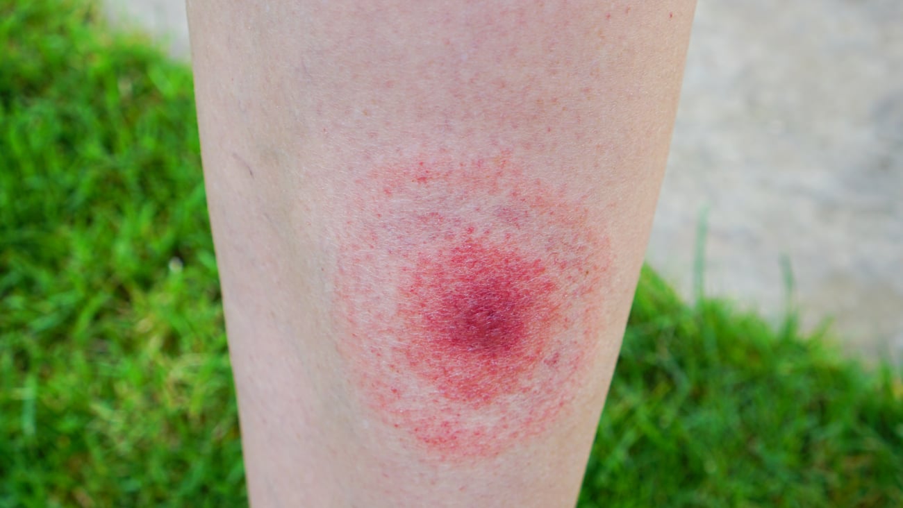 Bullseye rash from a tick bite on a white adult's leg