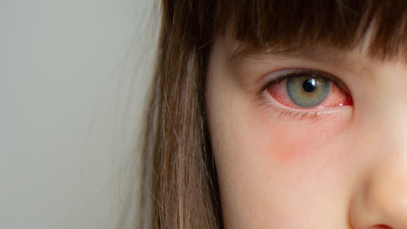 a young girl with one pink eye