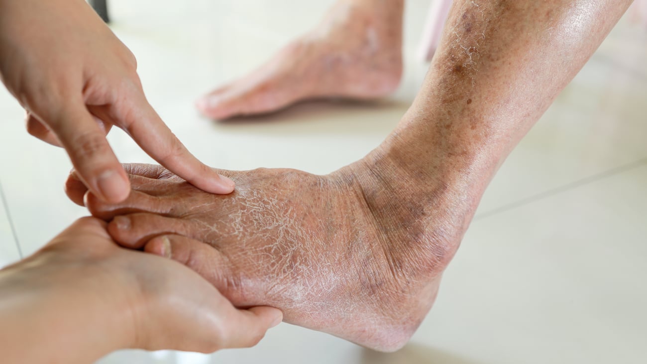 A close up of a foot with a skin problem