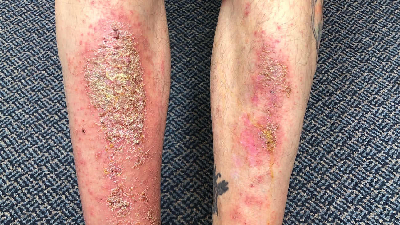 Leg rash