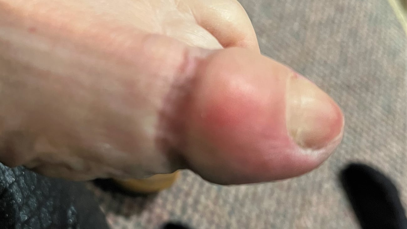 Case report: red toe