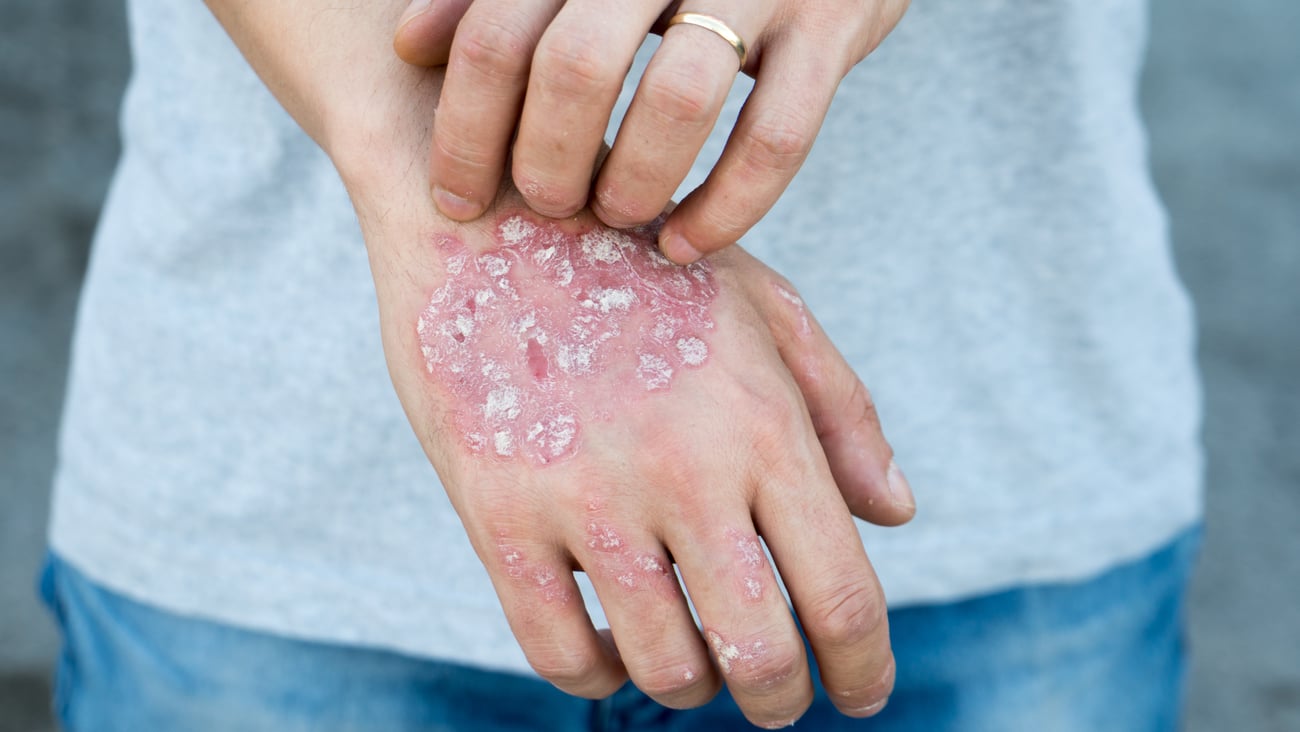 pustular psoriasis on hands