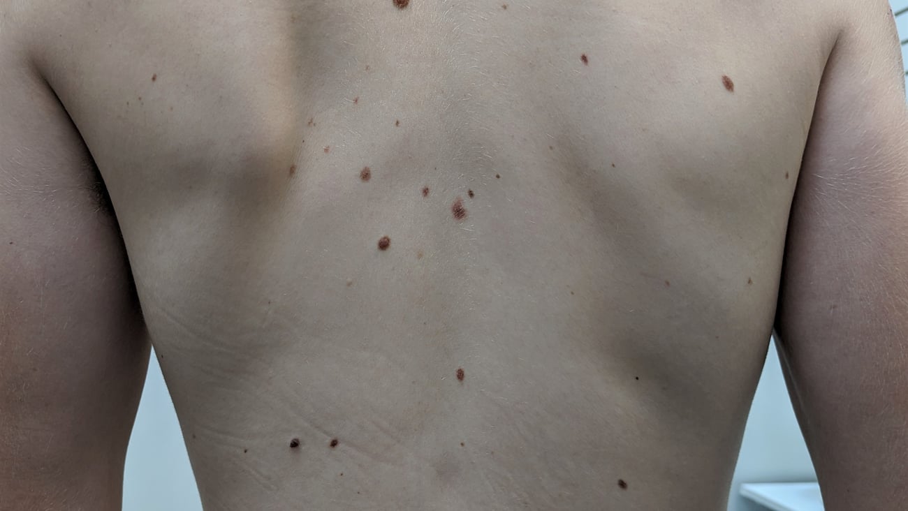 man with back rash