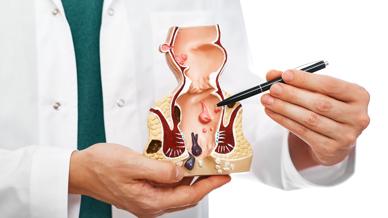Doctor holding plastic model of a cancerous colon
