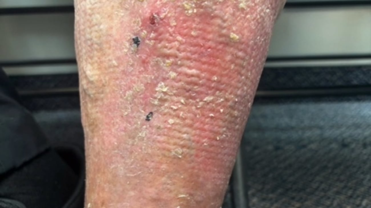 Rash on leg