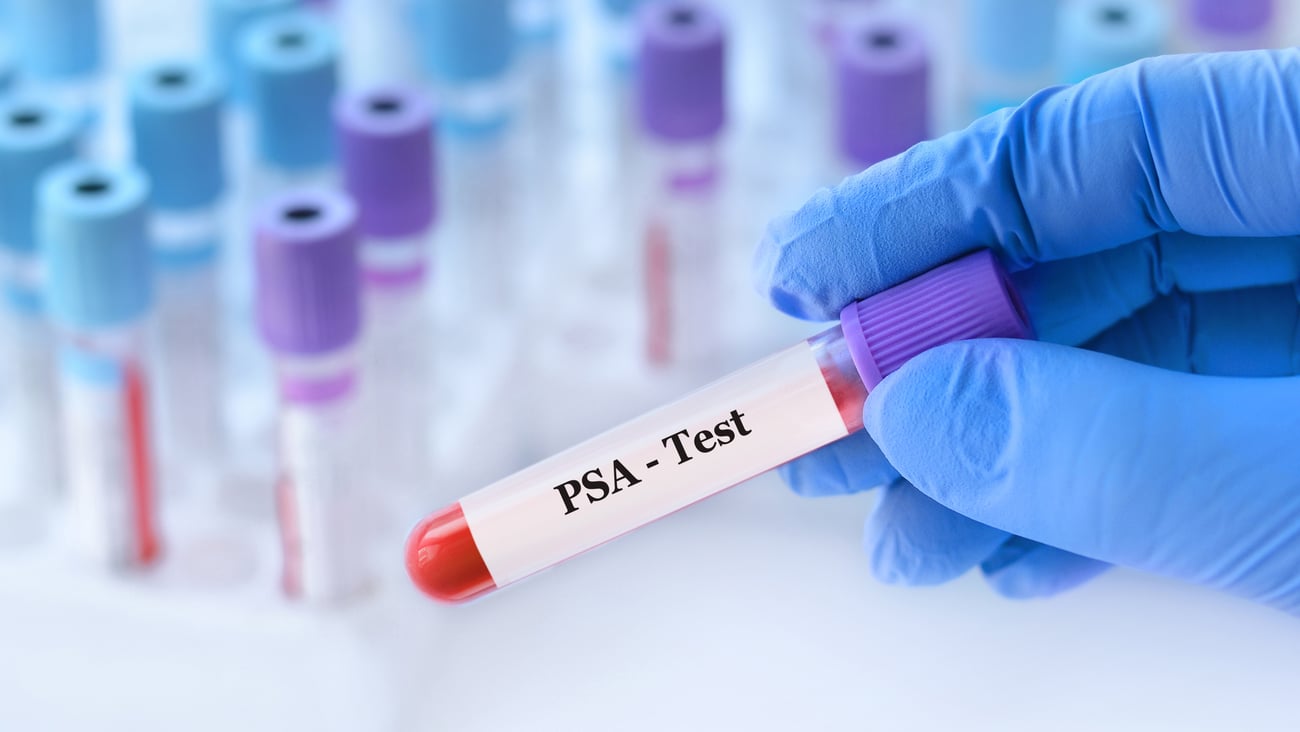 Hand wearing blue glove holds PSA test vial with more prostate cancer test vials in background.