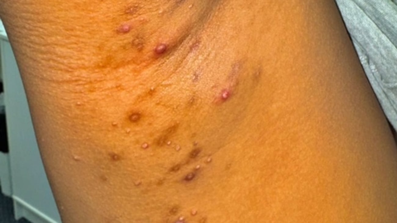 Under arm rash