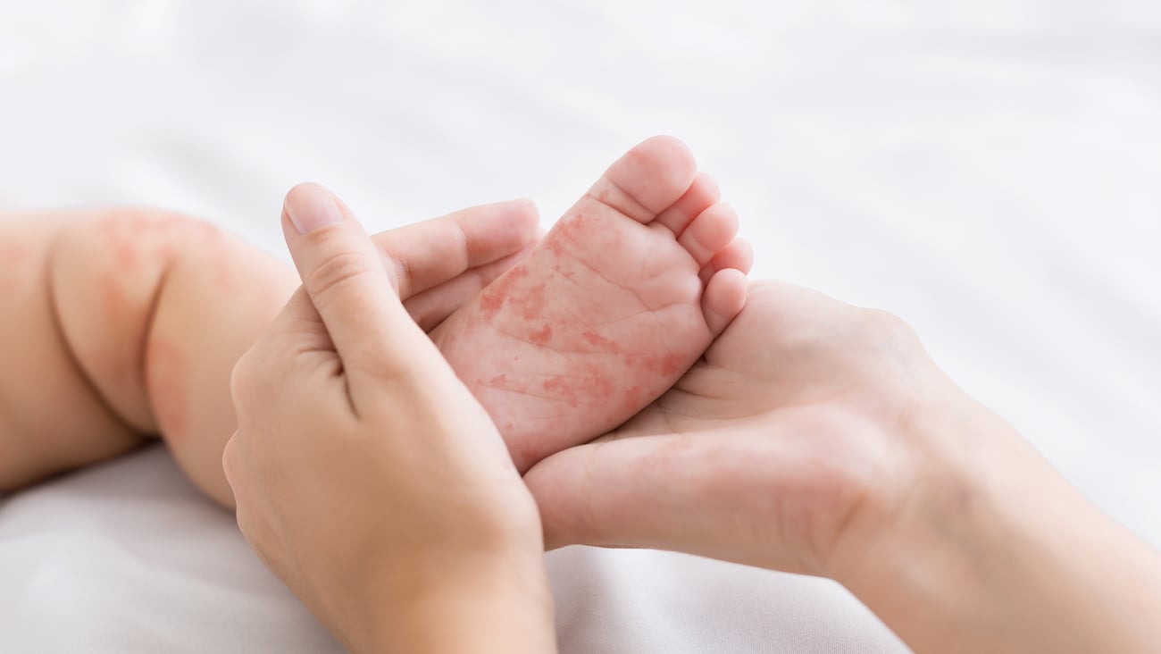 Fair-skinned baby's foot with measles rash