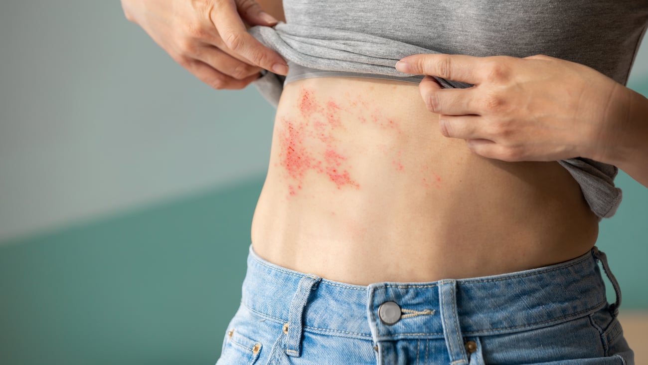 Fair-skinned woman pulling up her grey t-shirt to reveal a painful rash from herpes zoster