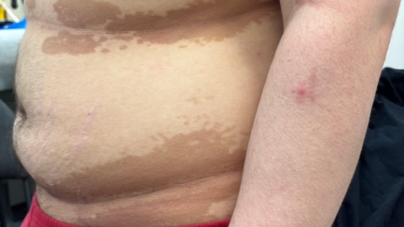 Close up of brown rash of fair-skinned man's torso from Dr. Robert Dickson's case reports