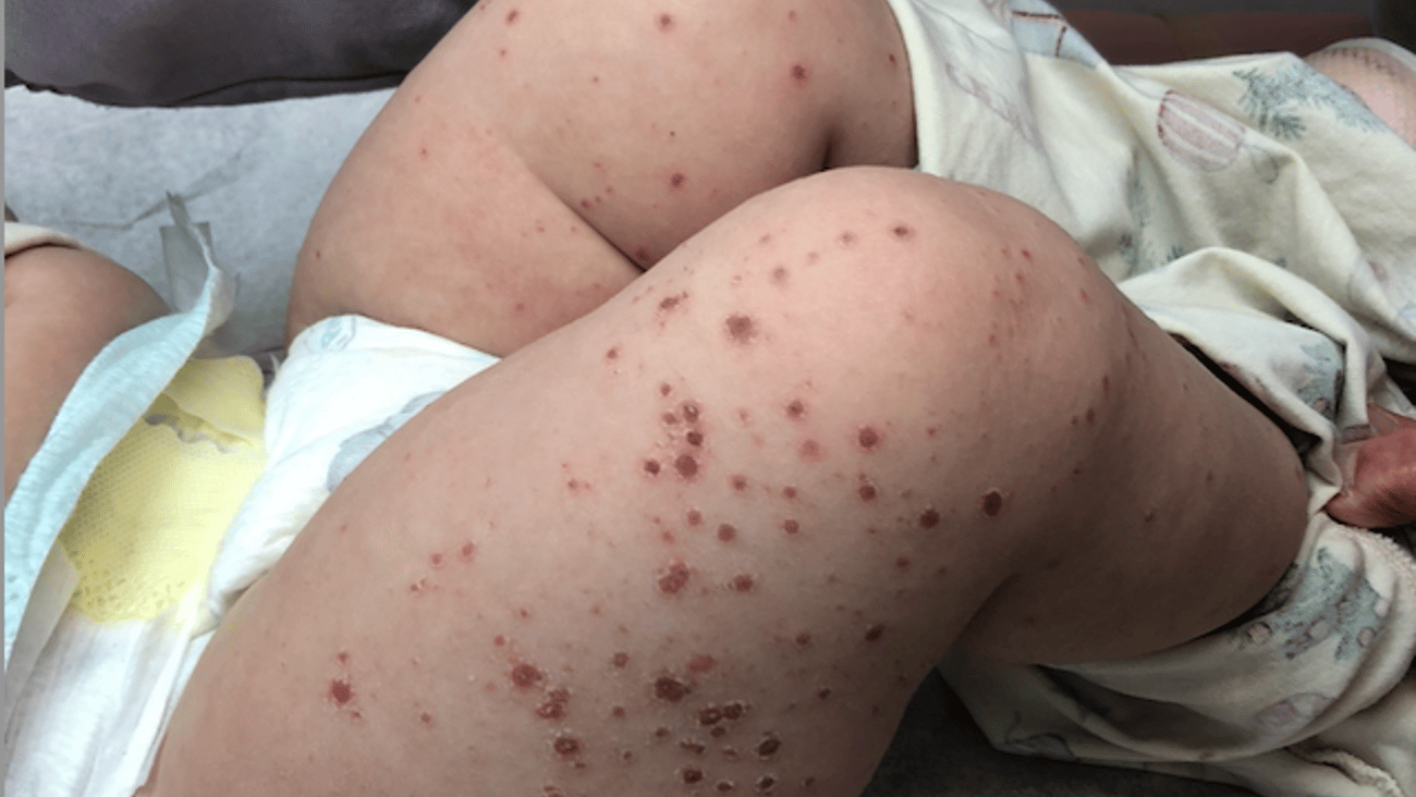 Fair-skinned baby with rash on legs