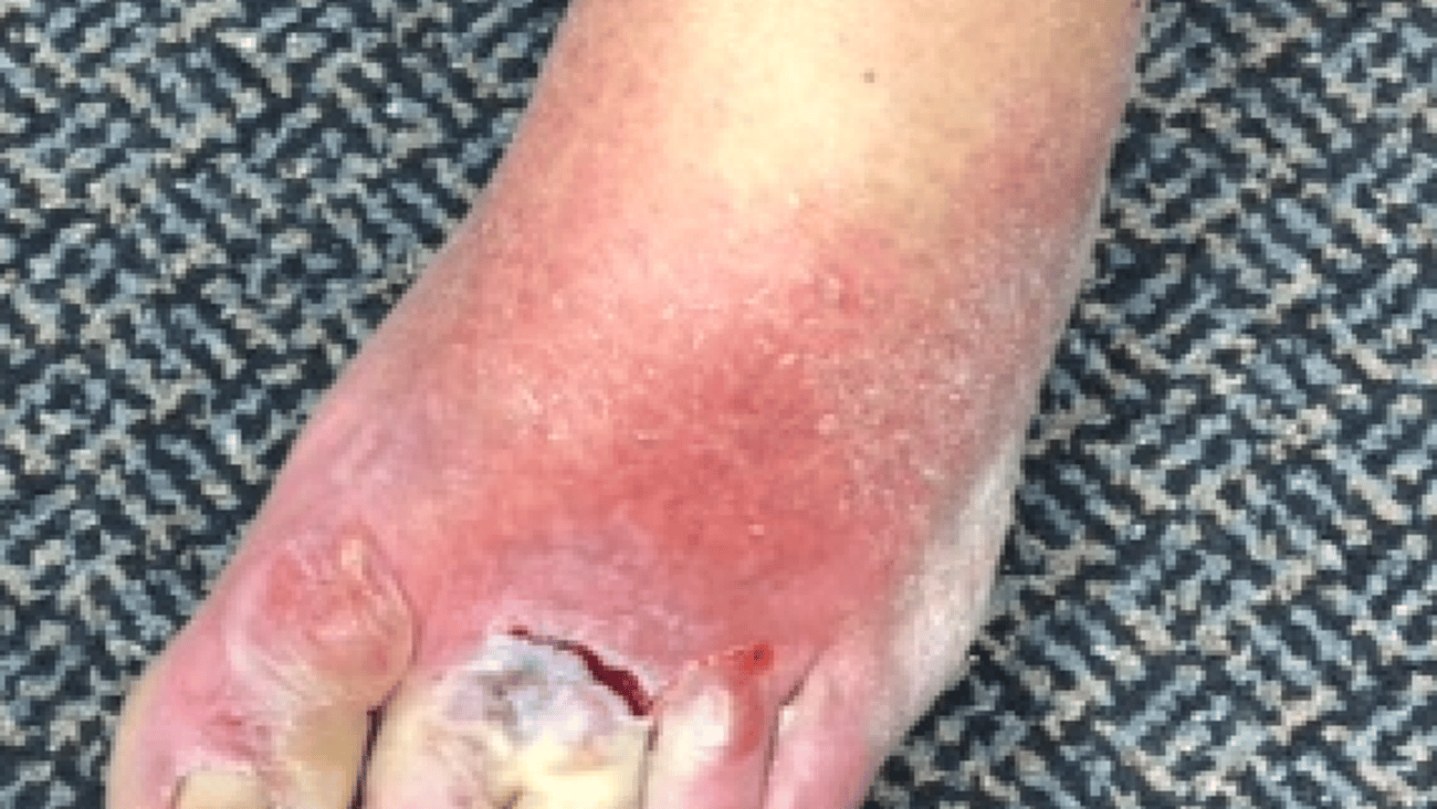 Photo of a foot with a rash and a deep cut near the two middle toes