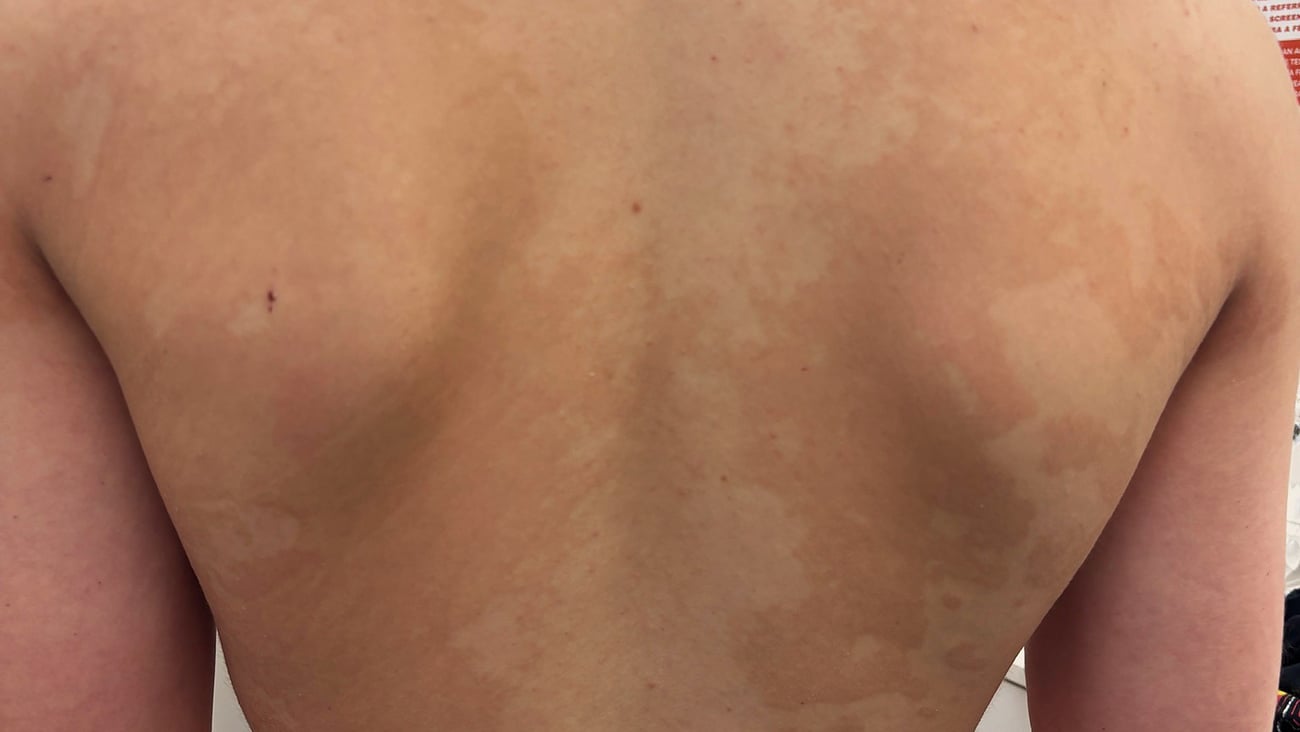 Young fair-skinned man's back with a blotchy white rash