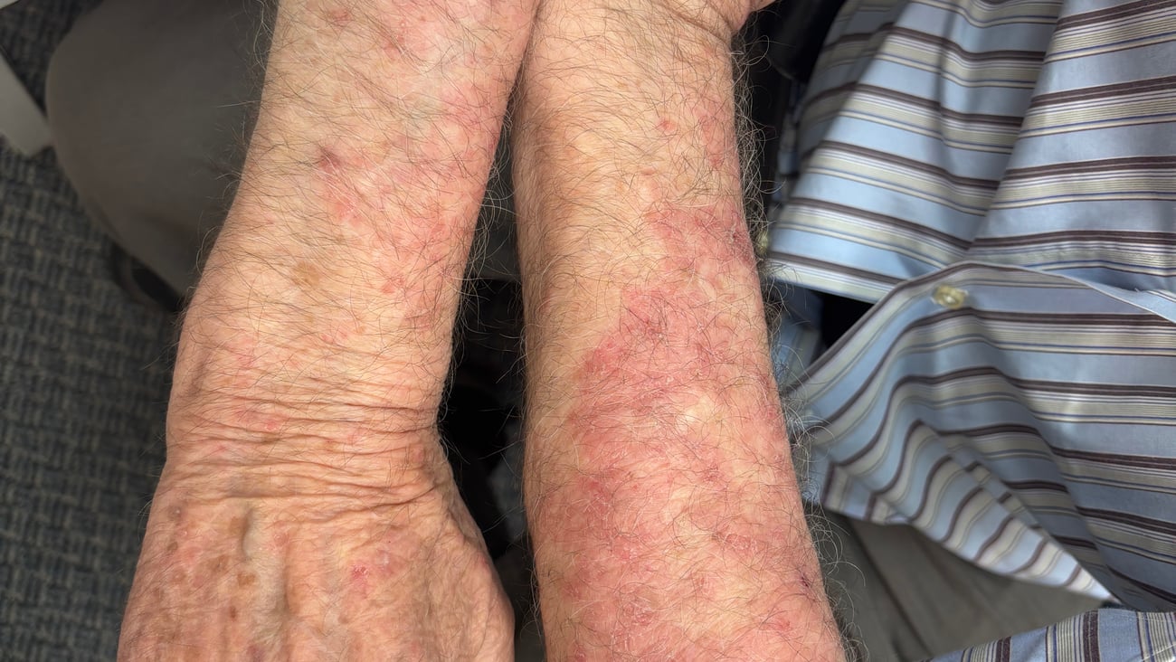 Close up of older white man's arms with red rash