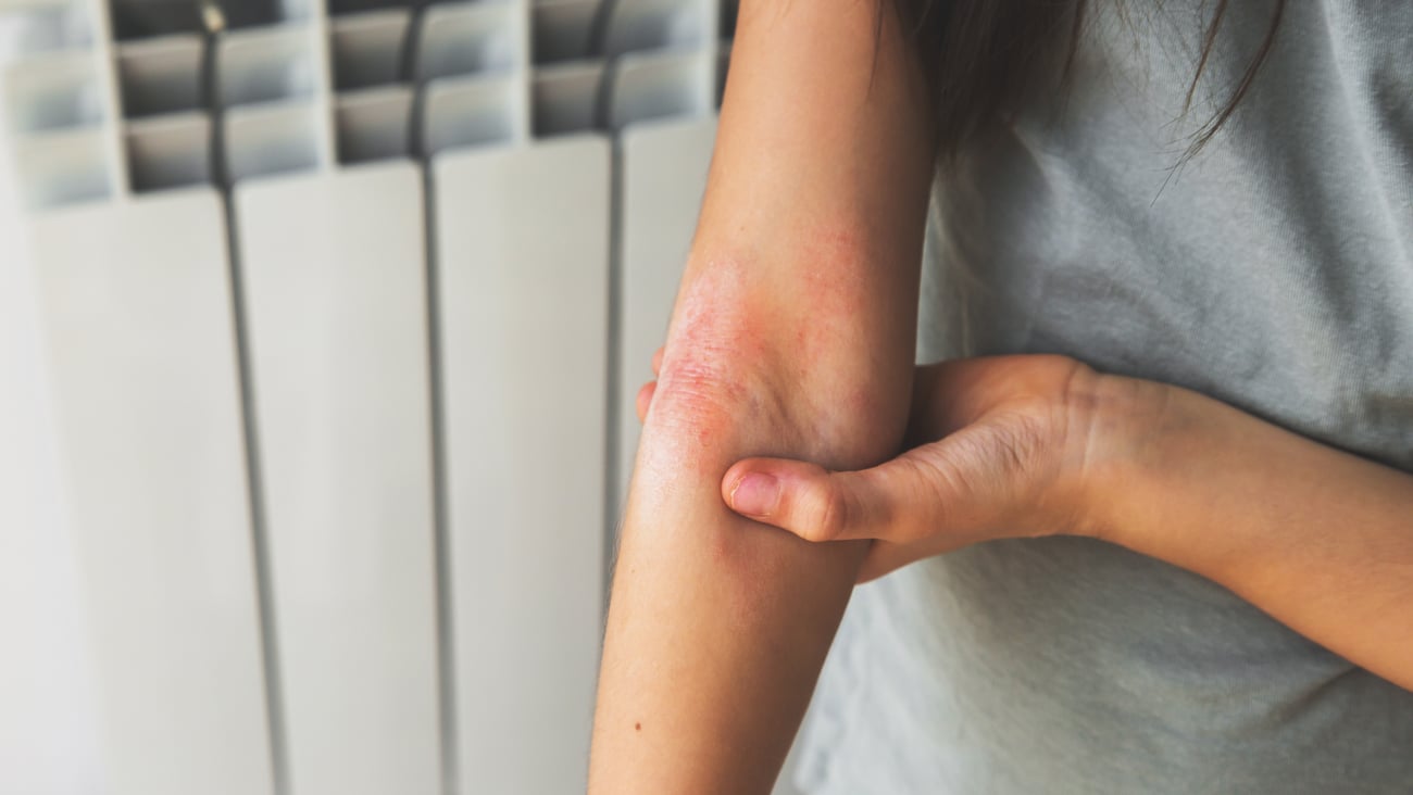 A girl shows her combed dry skin on the bend of her elbow, redness, roughness, itching from atopic dermatitis