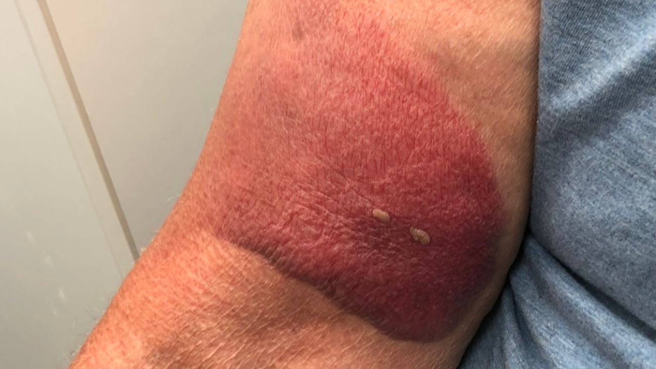 Older fair-skinned man with large bruise on his arm
