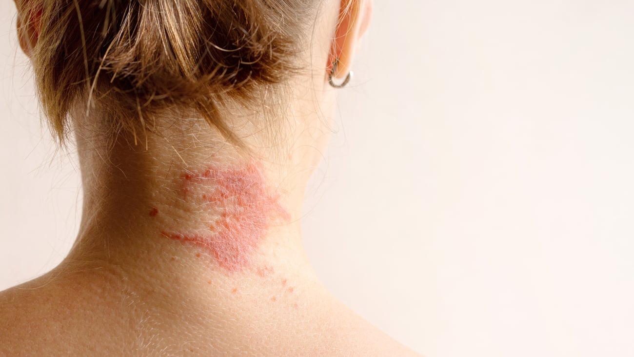 Manifestation of atopic dermatitis as a red itchy spot on a woman’s neck
