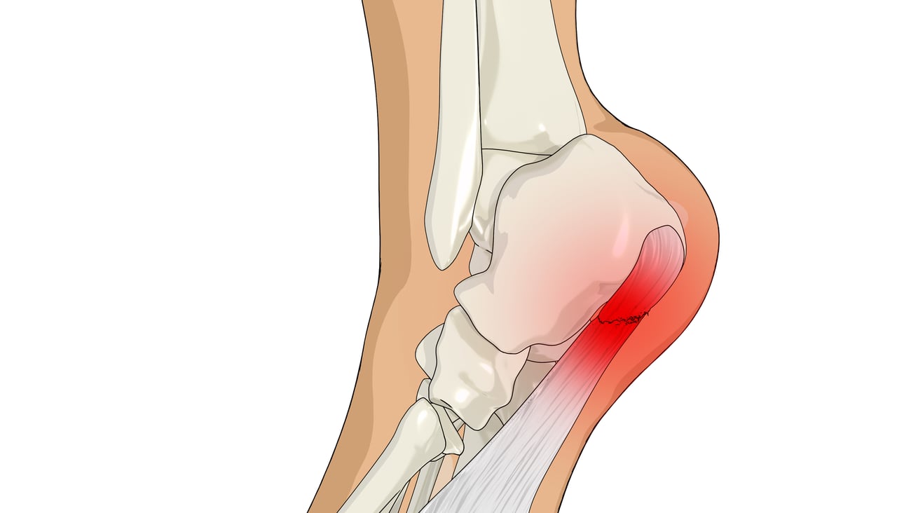 illustration of foot with heel, site of pain, in red