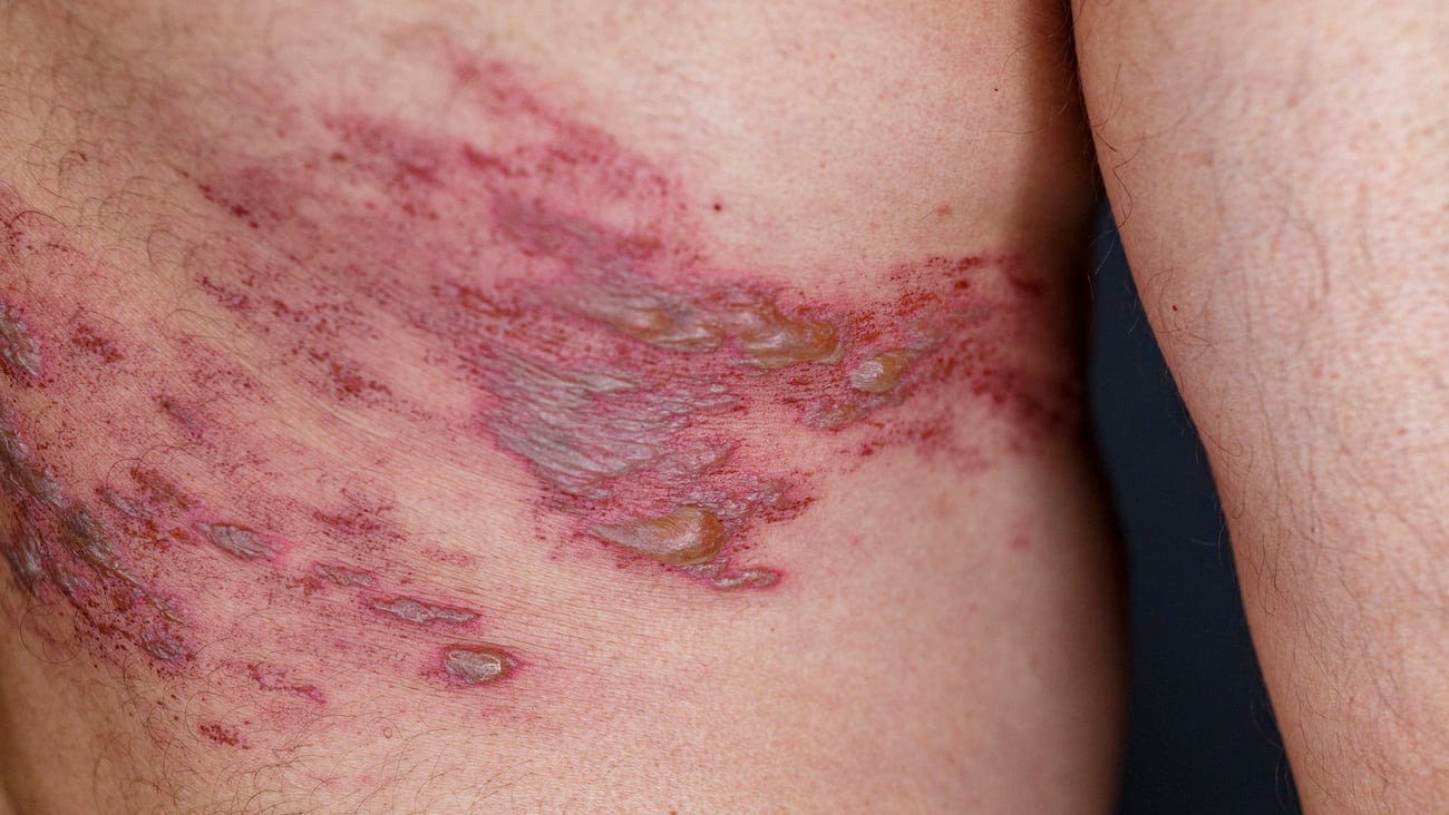 Close up a rash from herpes zoster infection