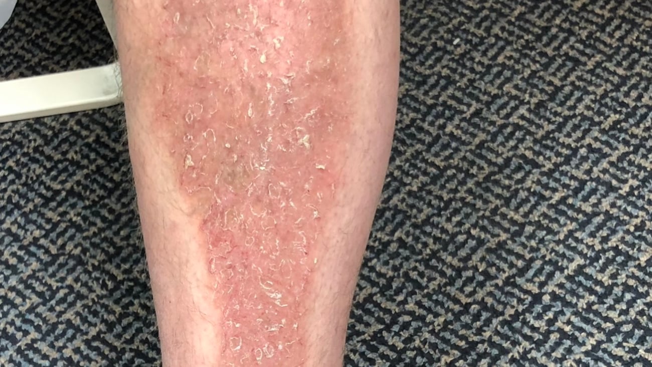 Man's leg with a rash on it
