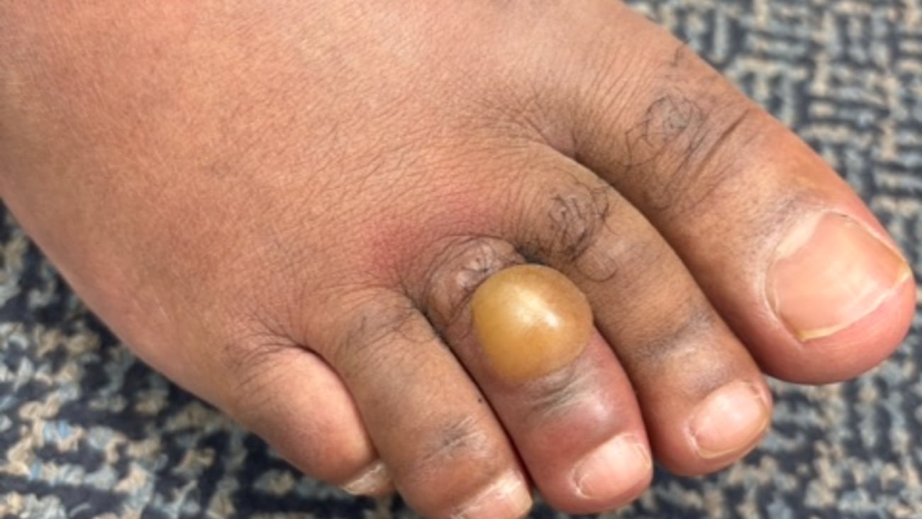 Close up of a swollen foot 