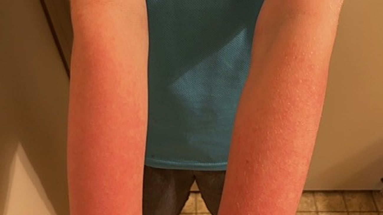 Child showing his sunburned arms