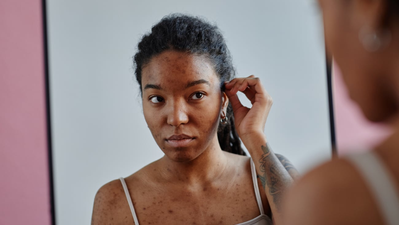 Young Black woman with acne scars looking in the mirror