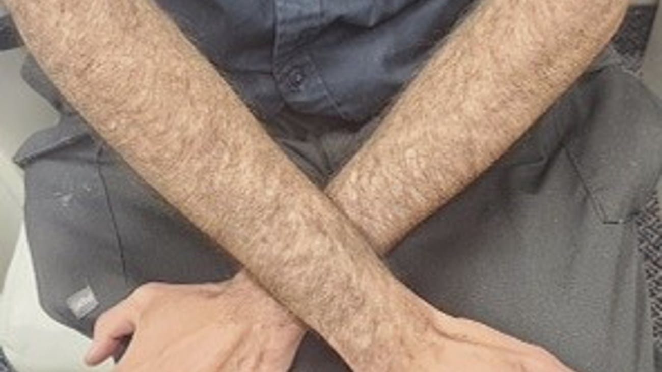 Fair-skinned man with a skin ailment, showing arms to the doctor