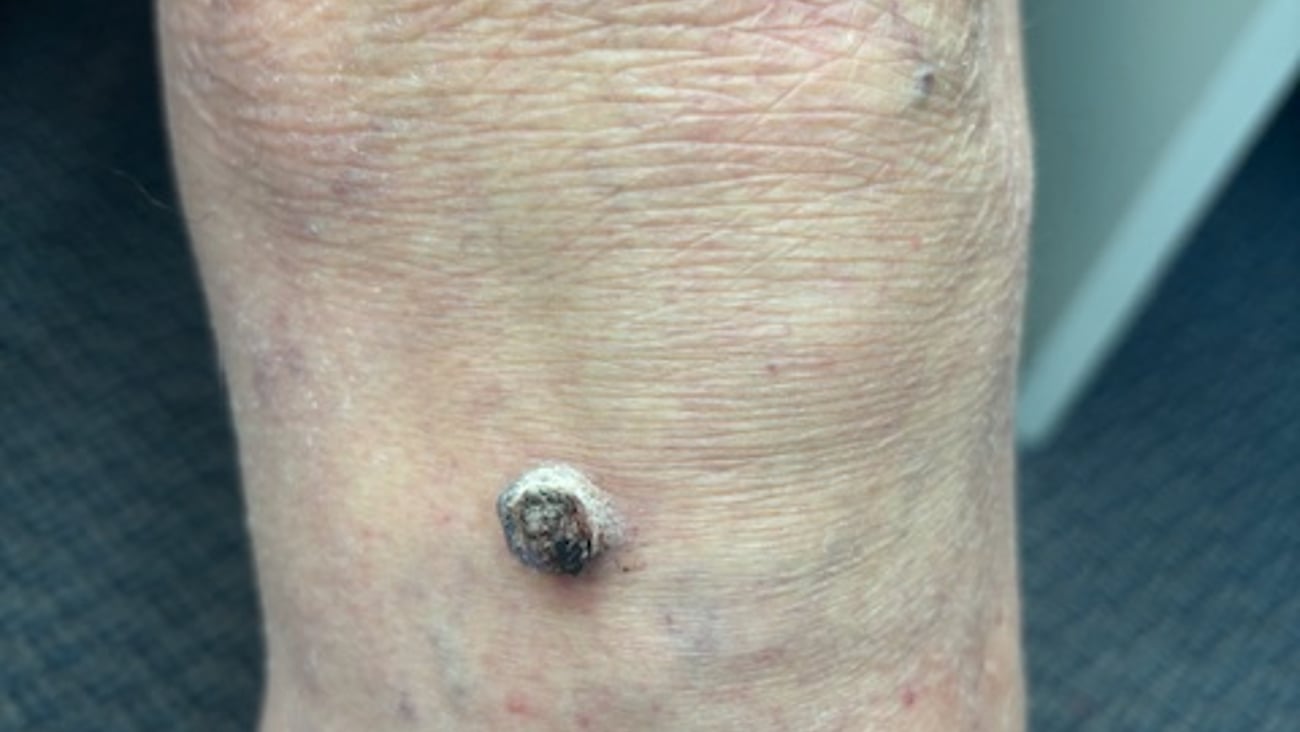 Fair-skinned man's leg with a black boil on it