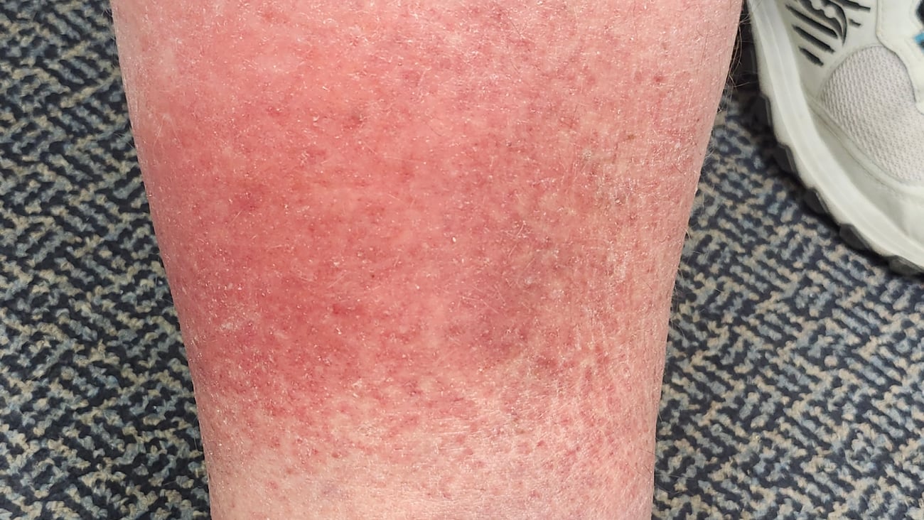 Fair-skinned patient's leg with red rash