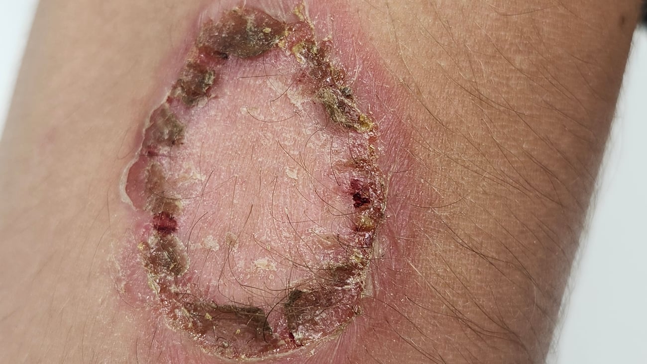 Leg with a round lesion