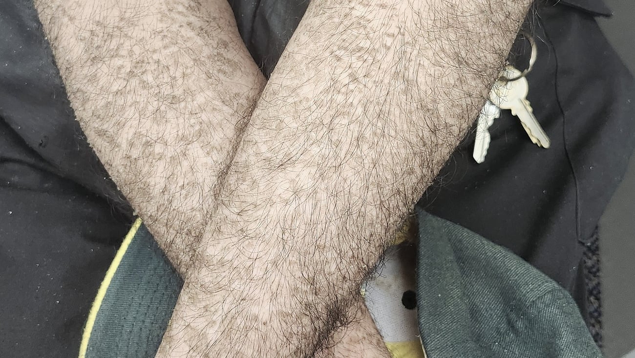 Arms of a patient with an unusual rash
