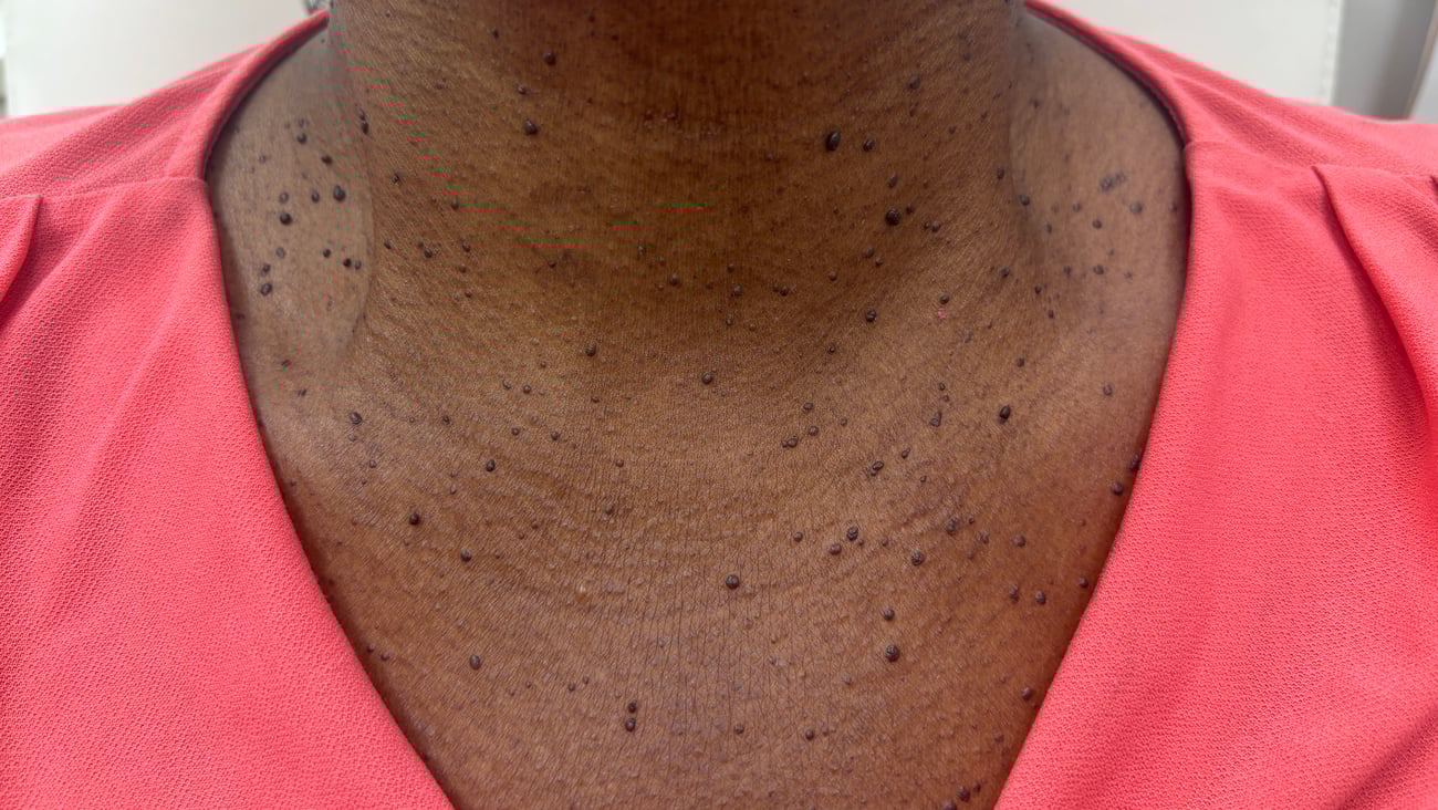A brown-skinned patient's upper chest