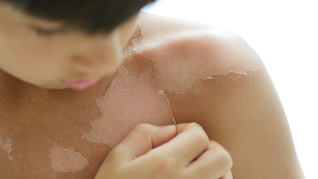 Young boy with picking at peeling skin from a bad sunburn 