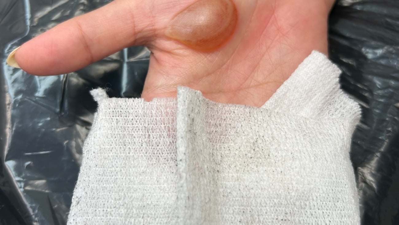 Patient's palm with large brown boil on it