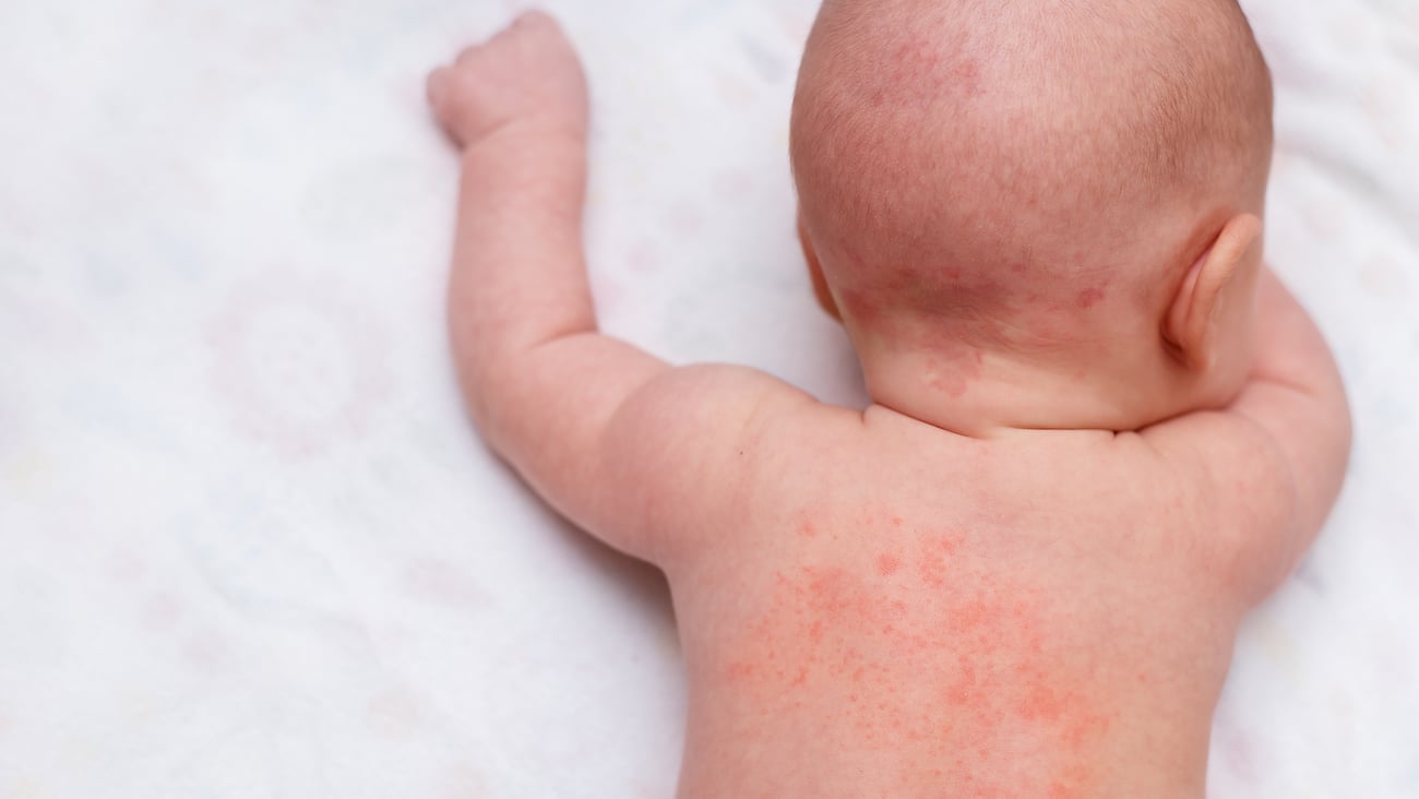 Fair-skinned baby with a red rash on its back