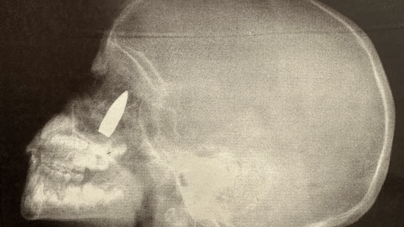 X-ray showing a bullet lodged in a patient's head