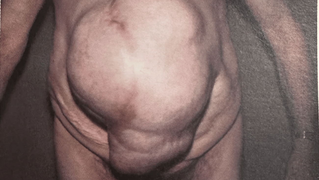 An enormous hernia in a patient's stomach area