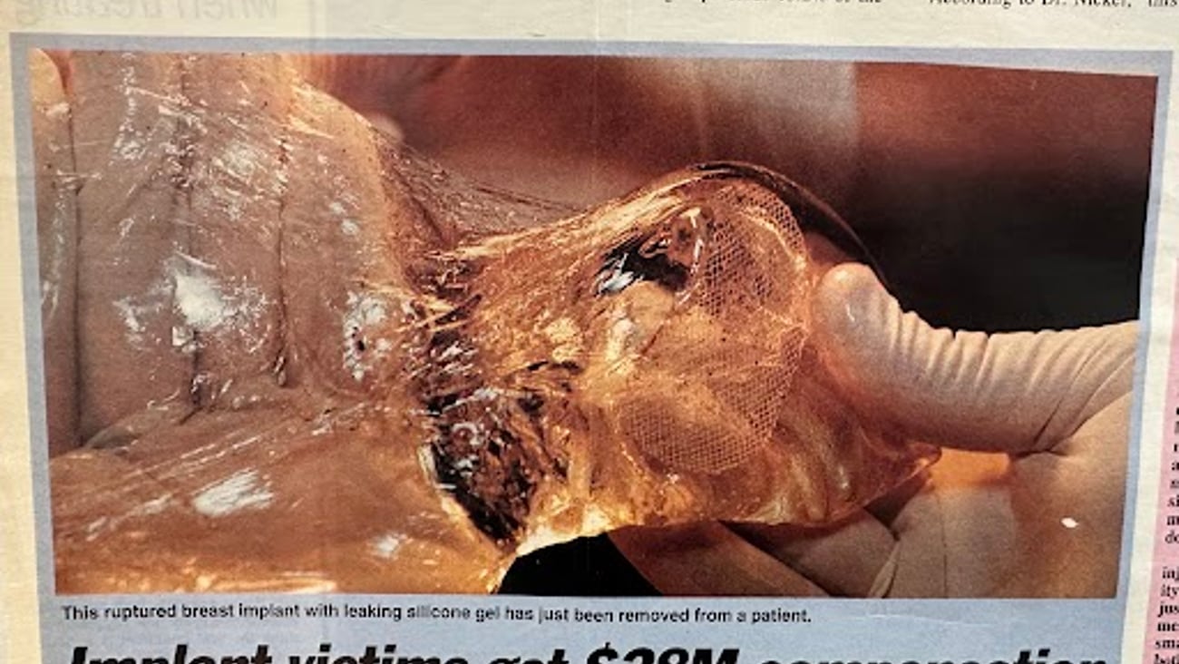 Breast implant after rupturing