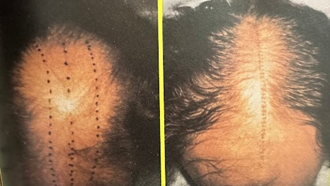 Before and after photos of scalp reduction surgery