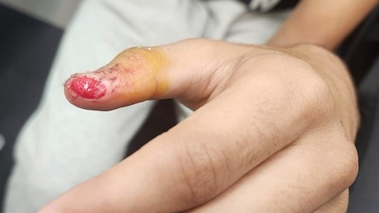 Close up of a patient's hand with a wound on the thumb