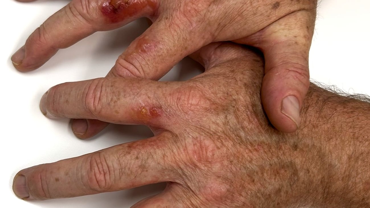 Birds-eye view of a patients hand with several blisters