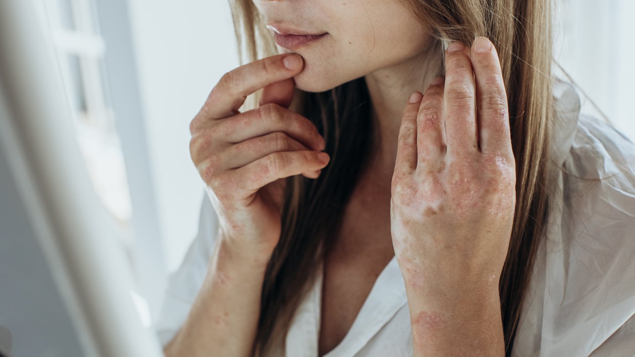 Young woman with rough skin from eczema on her hands