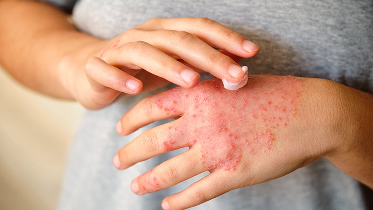 patient applies cream to inflamed hand