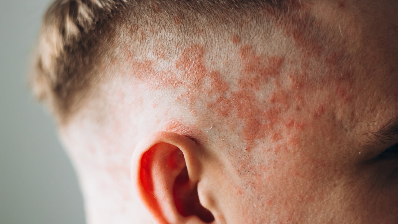 Man with psoriasis on the side if his head