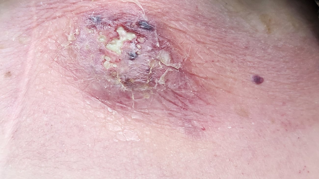 A large blister on a patient's trunk