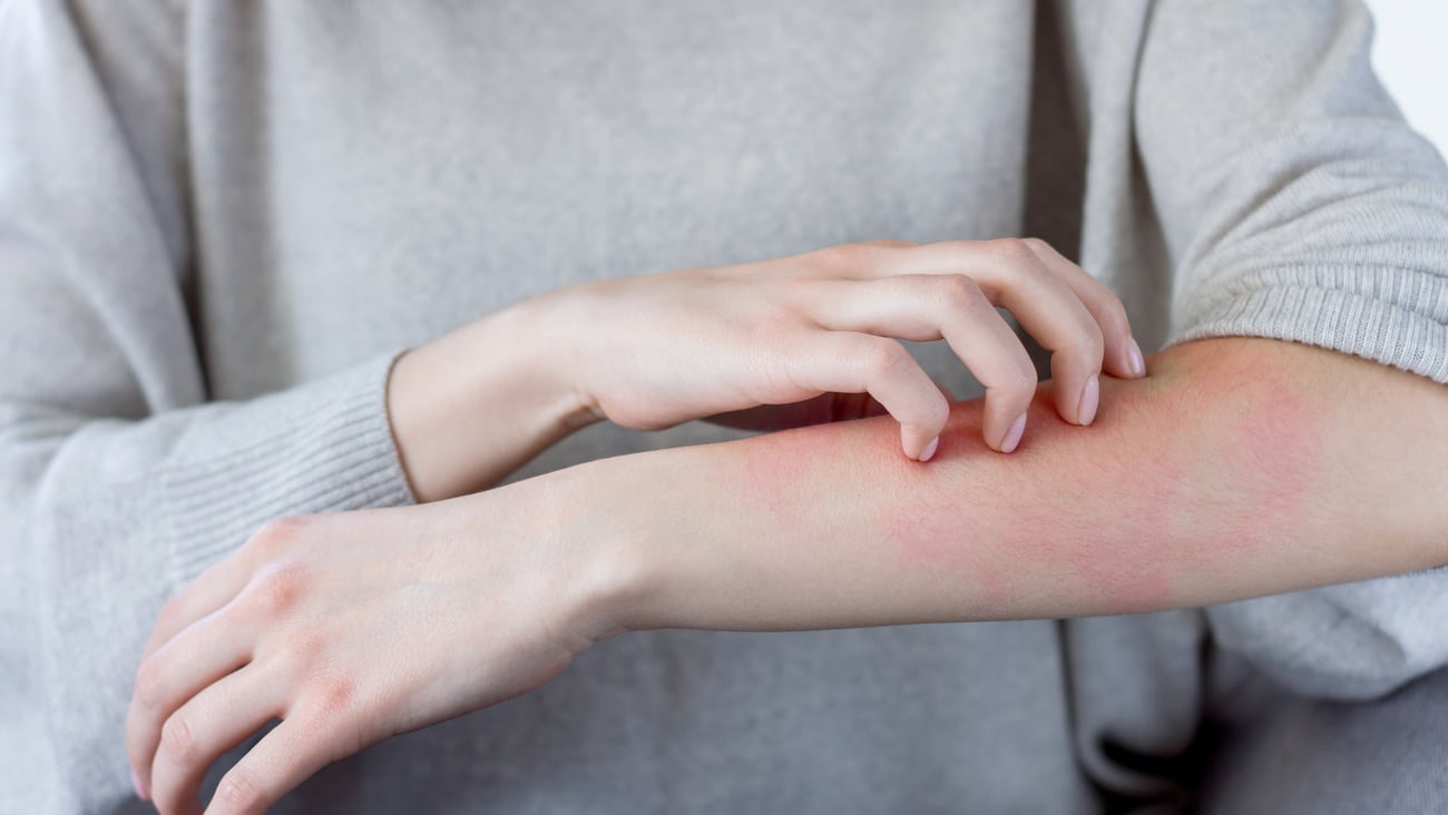 Young woman scratching a red rash on her arm