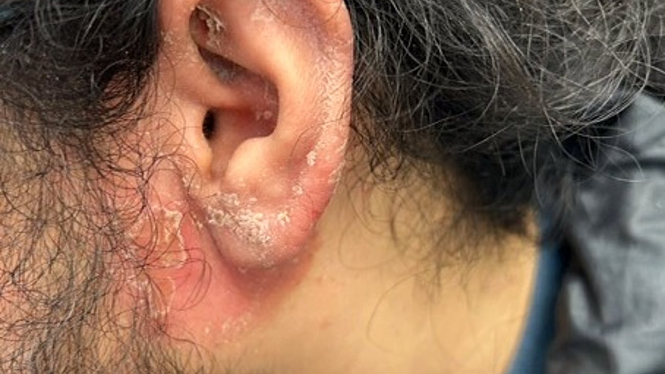 A patient with a rash on his ear