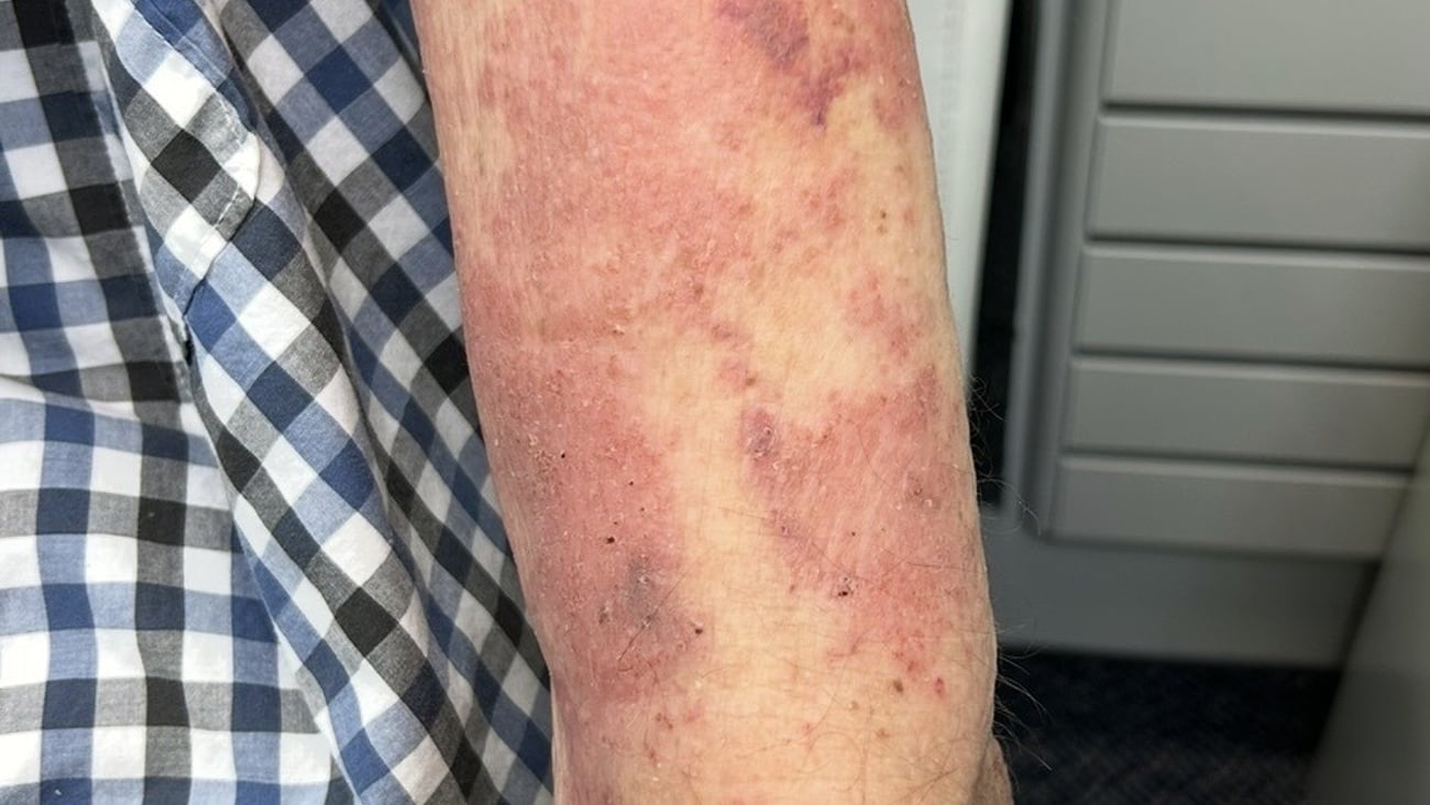 Close up of a patient's arm covered in bruises